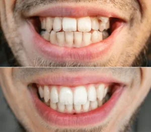 close-teeth-man-before-after-600nw-2310402103